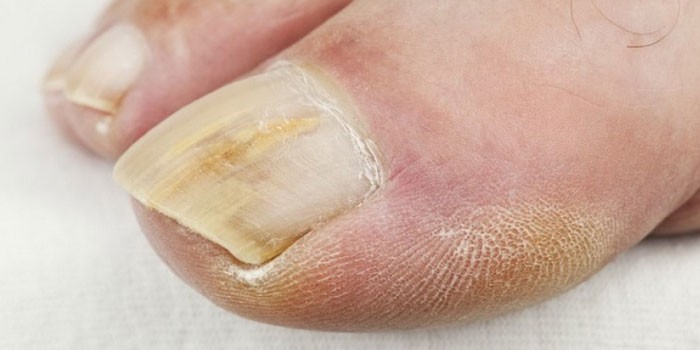 Вылечить грибок ногтей народными средствами быстро - самые эффективные рецепты с отзывами