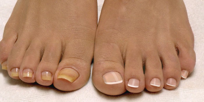 Желтый ноготь на большом пальце ноги - причины и лечение появления пятен, утолщения или изменения цвета